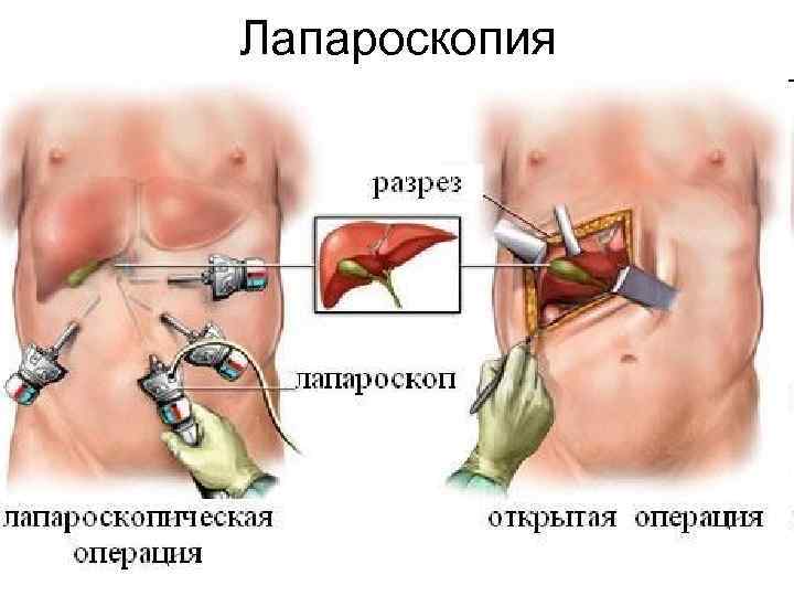 Лапароскопия 