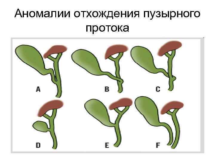 Аномалии отхождения пузырного протока 