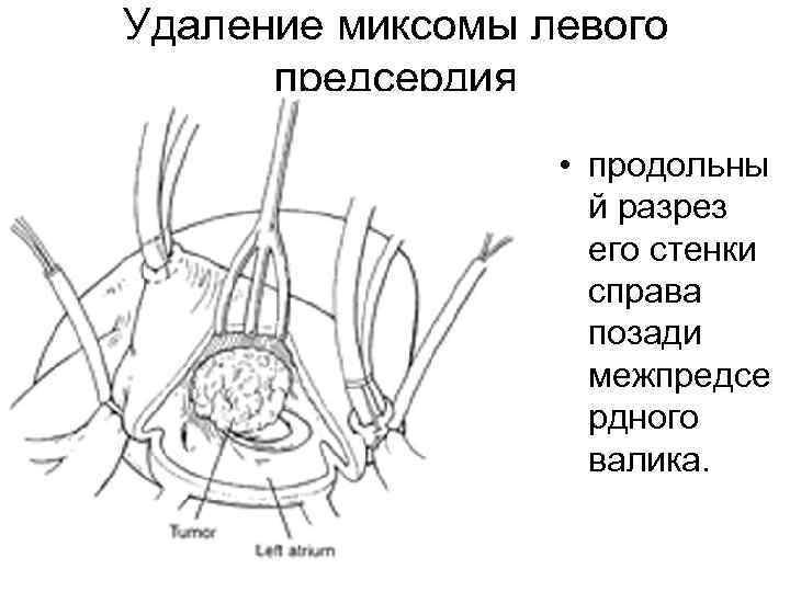 Удаление миксомы левого предсердия • продольны й разрез его стенки справа позади межпредсе рдного