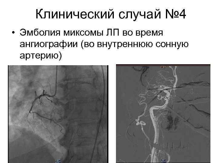 Клинический случай № 4 • Эмболия миксомы ЛП во время ангиографии (во внутреннюю сонную