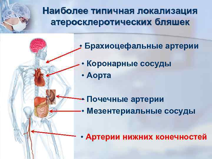 Наиболее типичная локализация атеросклеротических бляшек • Брахиоцефальные артерии • Коронарные сосуды • Аорта •