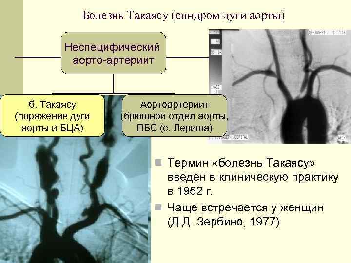 Болезнь Такаясу (синдром дуги аорты) Неспецифический аорто-артериит б. Такаясу (поражение дуги аорты и БЦА)