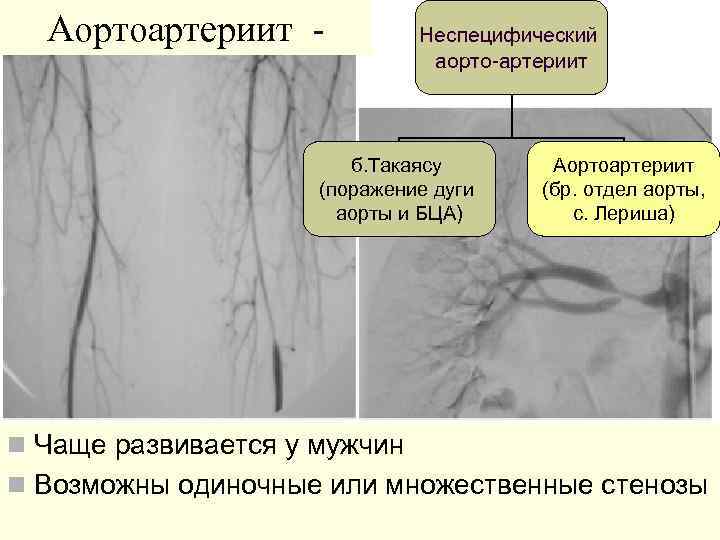 Аортоартериит - Неспецифический аорто-артериит б. Такаясу (поражение дуги аорты и БЦА) Аортоартериит (бр. отдел