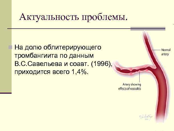 Актуальность проблемы. n На долю облитерирующего тромбангиита по данным В. С. Савельева и соавт.