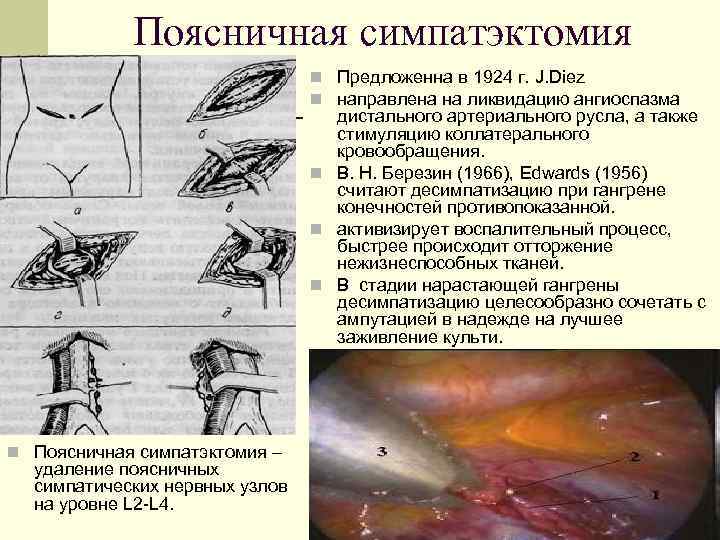 Поясничная симпатэктомия n Предложенна в 1924 г. J. Diez n направлена на ликвидацию ангиоспазма