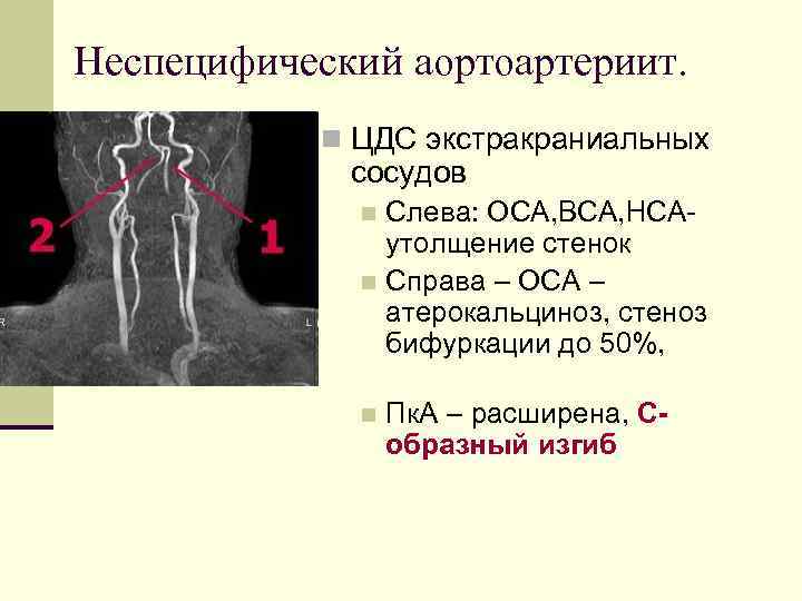 Неспецифический аортоартериит. n ЦДС экстракраниальных сосудов Слева: ОСА, ВСА, НСАутолщение стенок n Справа –