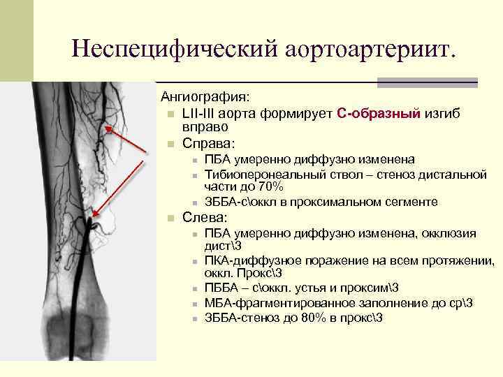 Неспецифический аортоартериит. n Ангиография: n n LII-III аорта формирует С-образный изгиб вправо Справа: n