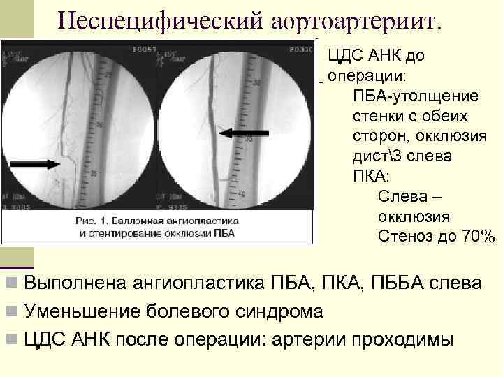 Неспецифический аортоартериит. ЦДС АНК до операции: ПБА-утолщение стенки с обеих сторон, окклюзия дист3 слева