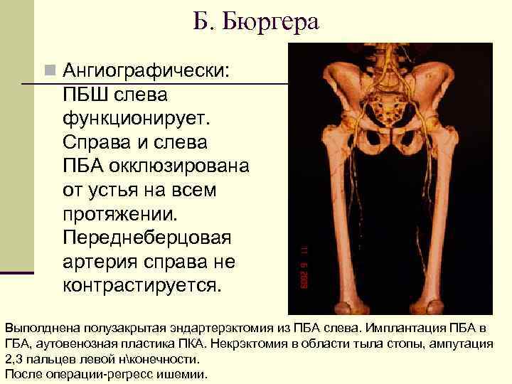 Б. Бюргера n Ангиографически: ПБШ слева функционирует. Справа и слева ПБА окклюзирована от устья