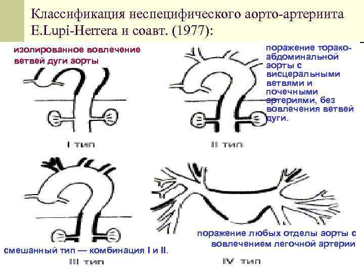 Классификация неспецифического аорто-артериита E. Lupi-Herrera и соавт. (1977): изолированное вовлечение ветвей дуги аорты смешанный