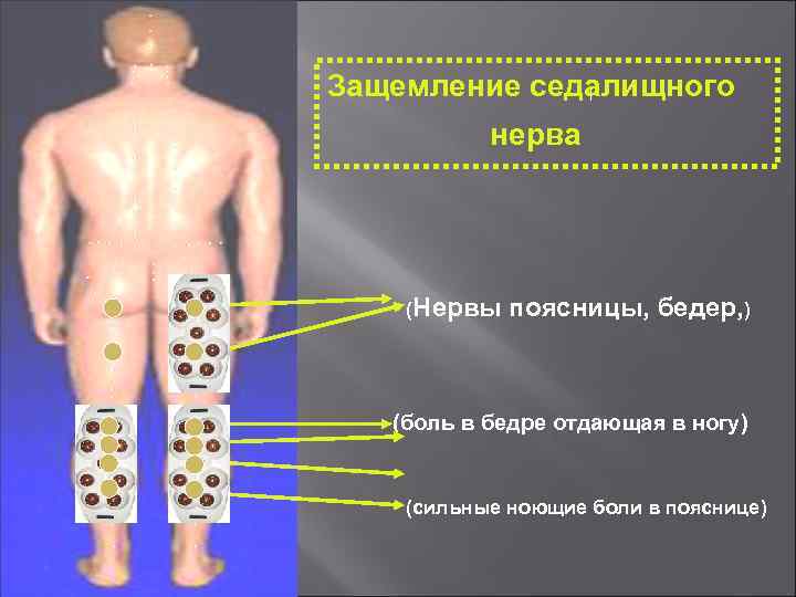 Защемление седалищного нерва (Нервы поясницы, бедер, ) (боль в бедре отдающая в ногу) (сильные