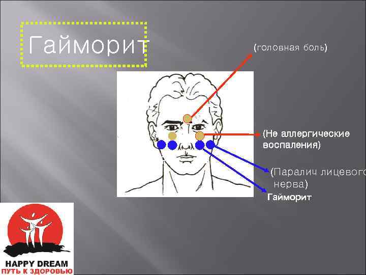 Боли при гайморите. Нервы на лбу. Гайморит головная боль.