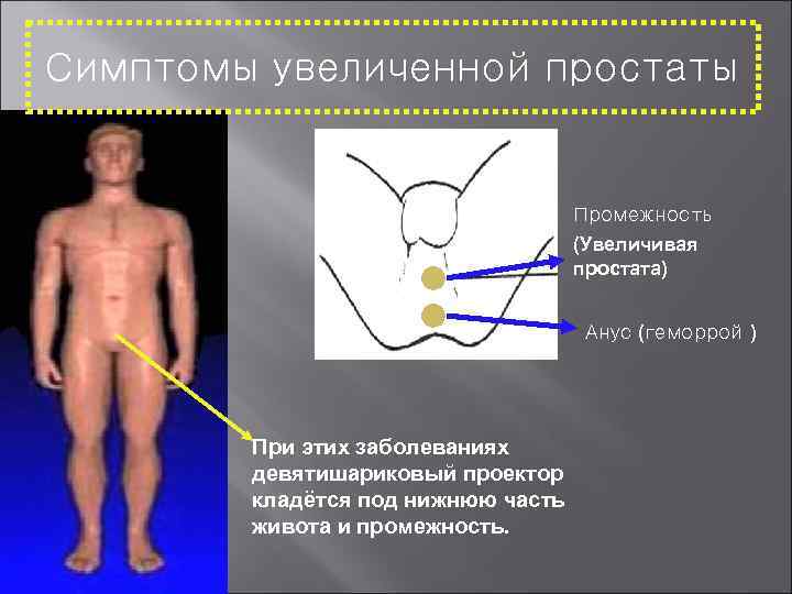 Симптомы увеличенной простаты Промежность (Увеличивая простата) Анус (геморрой ) При этих заболеваниях девятишариковый проектор