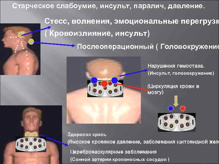 Старческое слабоумие, инсульт, паралич, давление. Стесс, волнения, эмоциональные перегрузк ( Кровоизлияние, инсульт) Послеоперационный (