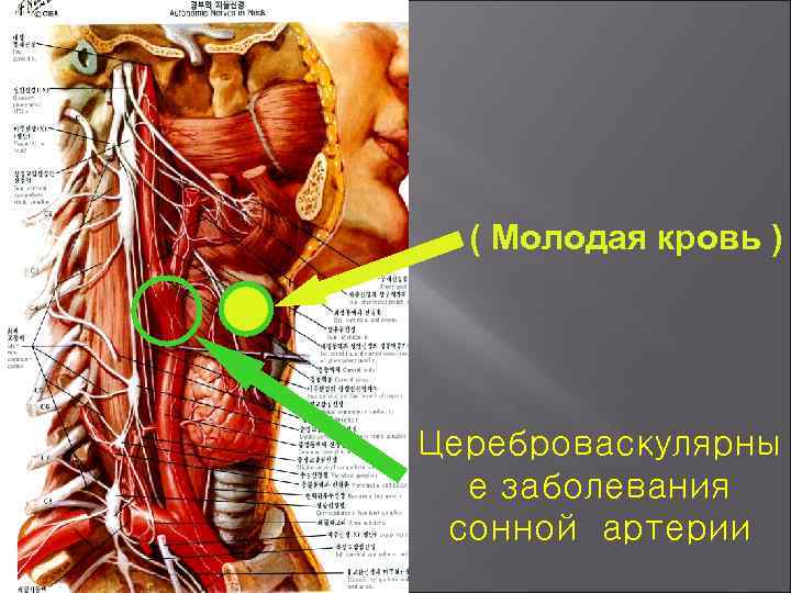 ( Молодая кровь ) Цереброваскулярны е заболевания сонной артерии 