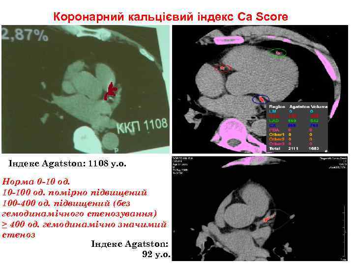 Коронарний кальцієвий індекс Ca Score Iндекс Agatston: 1108 у. о. Норма 0 -10 од.