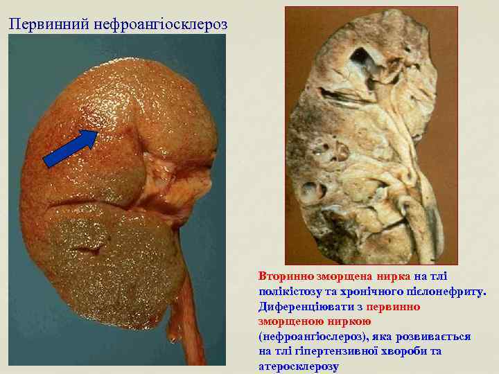 Первинний нефроангіосклероз Вторинно зморщена нирка на тлі полікістозу та хронічного пієлонефриту. Диференціювати з первинно