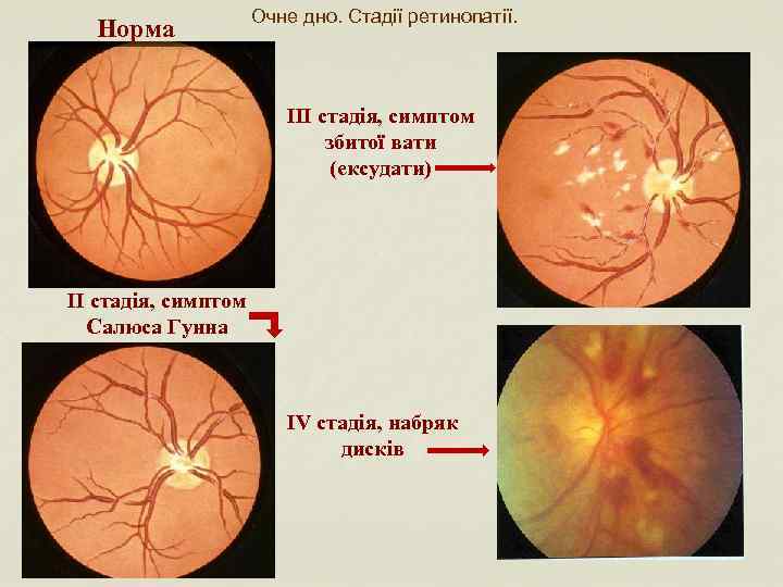 Норма Очне дно. Стадії ретинопатії. ІІІ стадія, симптом збитої вати (ексудати) ІІ стадія, симптом