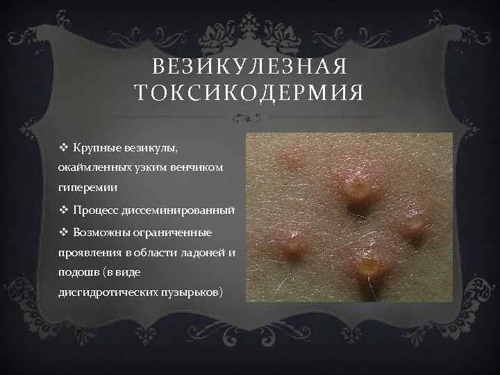 ВЕЗИКУЛЕЗНАЯ ТОКСИКОДЕРМИЯ v Крупные везикулы, окаймленных узким венчиком гиперемии v Процесс диссеминированный v Возможны