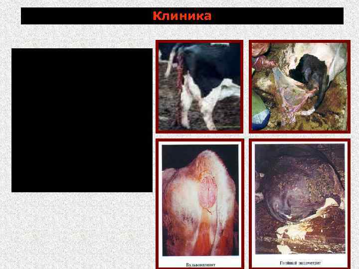 Клиника задержание последа; гнойный эндометрит. воспаление яичников и фаллопиевых труб; нарушение полового цикла и