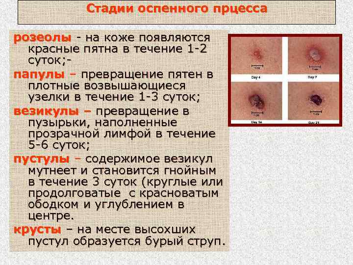 Стадии оспенного прцесса розеолы - на коже появляются красные пятна в течение 1 -2