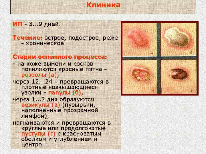 Клиника ИП - 3. . . 9 дней. Течение: острое, подострое, реже - хроническое.