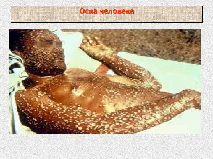 Оспа человека 