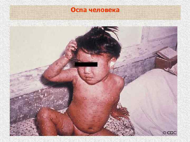 Оспа человека 