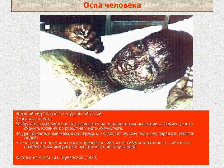 Оспа человека Внешний вид больного натуральной оспой. Оспенные папулы. Возбудитель максимально накапливается на ранней