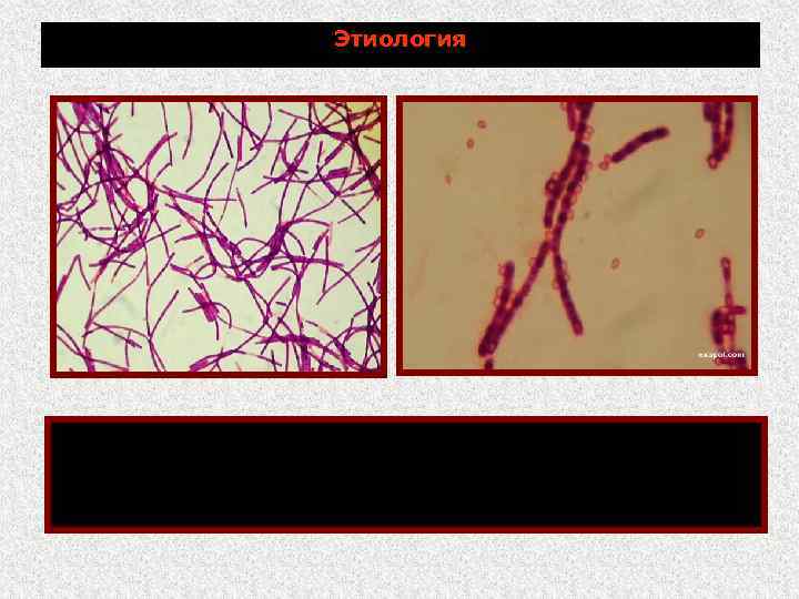 Этиология в мазках из культур обнаруживают длинные цепочки В мазках концы палочек в цепочках