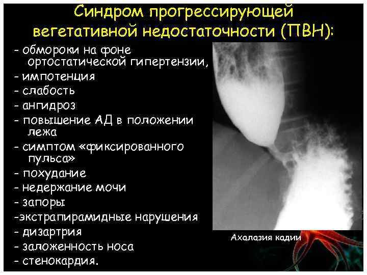 Синдром прогрессирующей вегетативной недостаточности (ПВН): - обмороки на фоне ортостатической гипертензии, - импотенция -