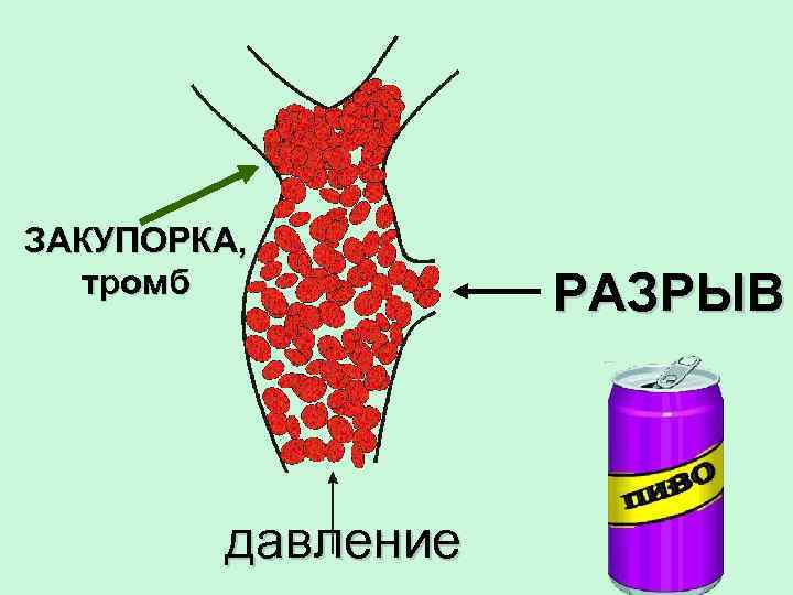 ЗАКУПОРКА, тромб давление РАЗРЫВ 