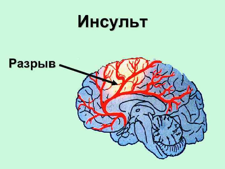 Инсульт Разрыв 