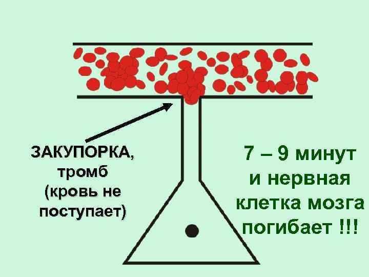 ЗАКУПОРКА, тромб (кровь не поступает) 7 – 9 минут и нервная клетка мозга погибает