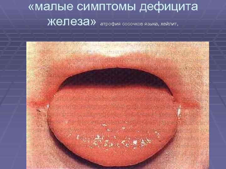  «малые симптомы дефицита железа» атрофия сосочков языка, хейлит, 