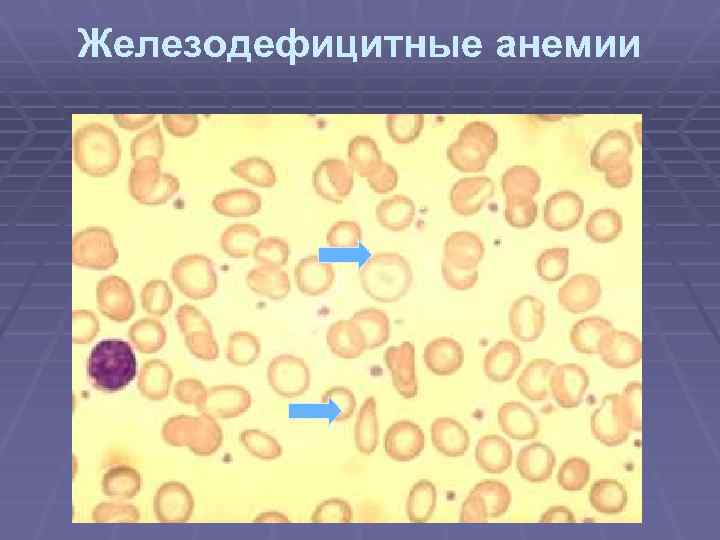 Железодефицитная анемия картина крови