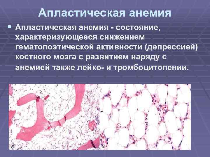 Апластическая анемия рисунок