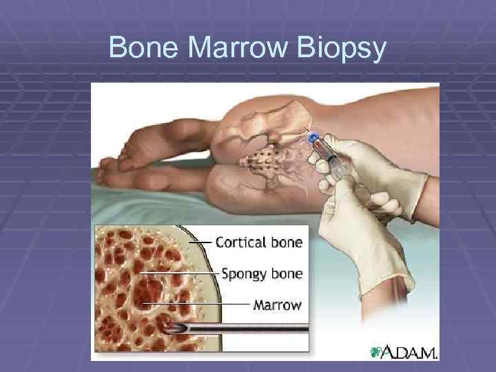 Bone Marrow Biopsy 