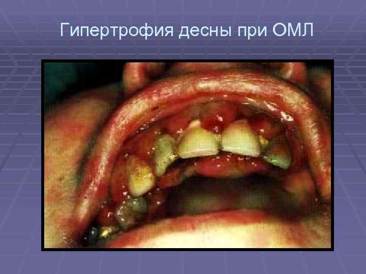 Гипертрофия десны при ОМЛ 