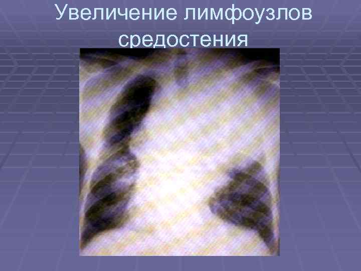 Увеличение лимфоузлов средостения 