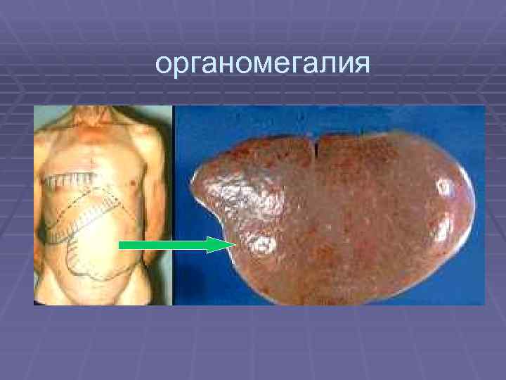 органомегалия 