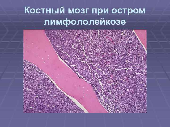 Костный мозг при остром лимфололейкозе 