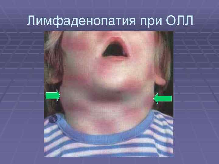 Лимфаденопатия при ОЛЛ 