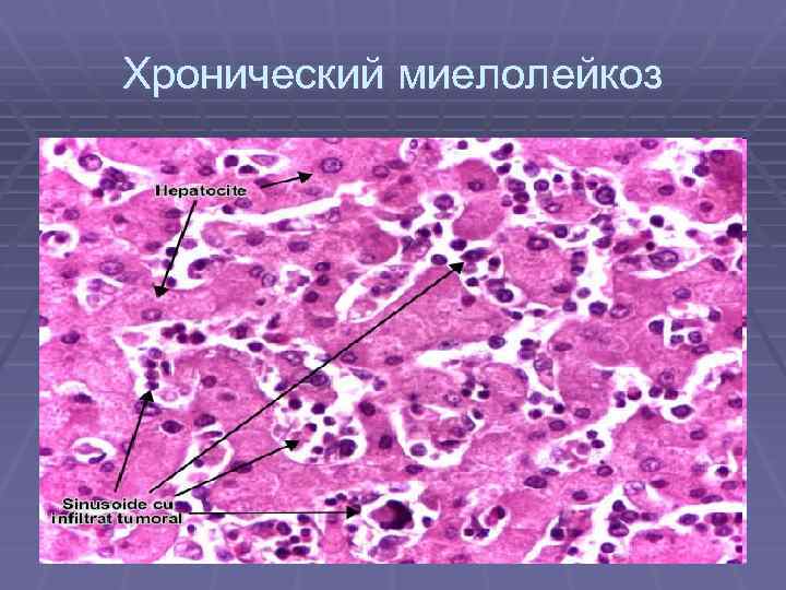 Хронический миелолейкоз 