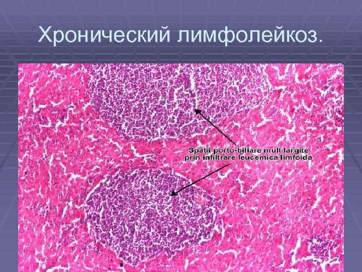 Хронический лимфолейкоз. 
