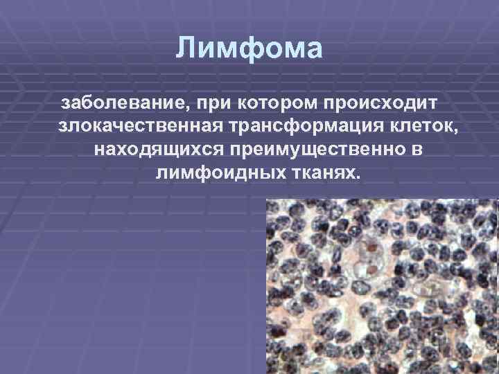 Лимфома заболевание, при котором происходит злокачественная трансформация клеток, находящихся преимущественно в лимфоидных тканях. 
