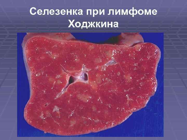 Селезенка при лимфоме Ходжкина 