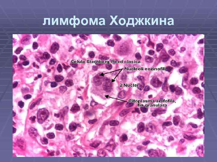 лимфома Ходжкина 