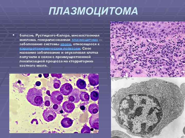 ПЛАЗМОЦИТОМА § болезнь Рустицкого Калера, множественная миелома, генерализованная плазмоцитома — заболевание системы крови, относящееся