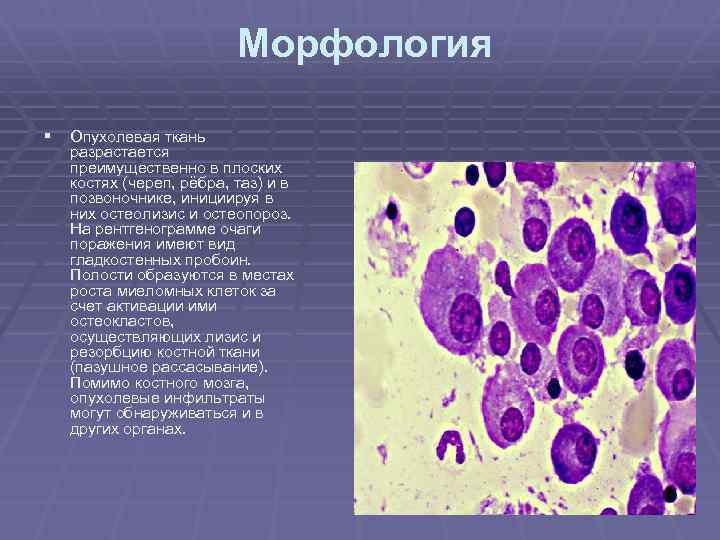  Морфология § Опухолевая ткань разрастается преимущественно в плоских костях (череп, рёбра, таз) и